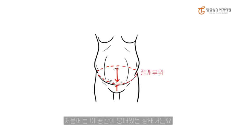 복부거상술, 늘어진 뱃살은 지방의 문제가 아닙니다 사진 3