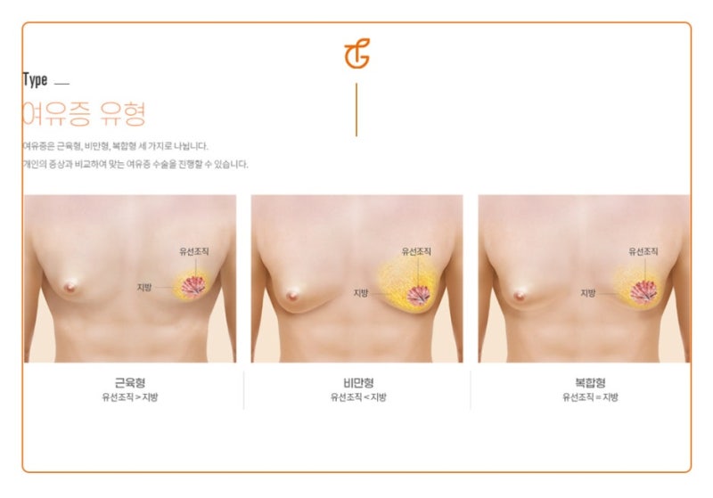 여성형 유방증 원인과 치료방법! 사진 5