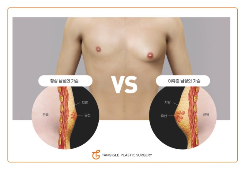 여성형 유방증 원인과 치료방법! 사진 4