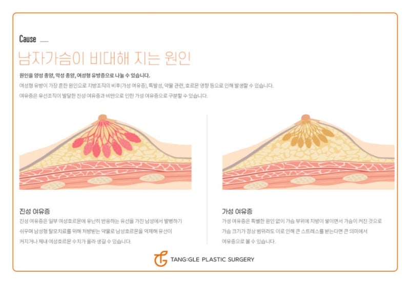 여성형 유방증 원인과 치료방법!