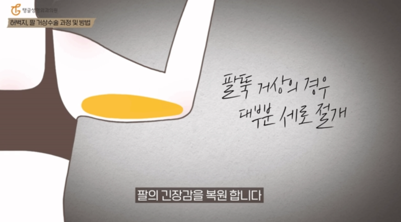 팔뚝거상술, 흉터 때문에 고민하시나요? 사진 3