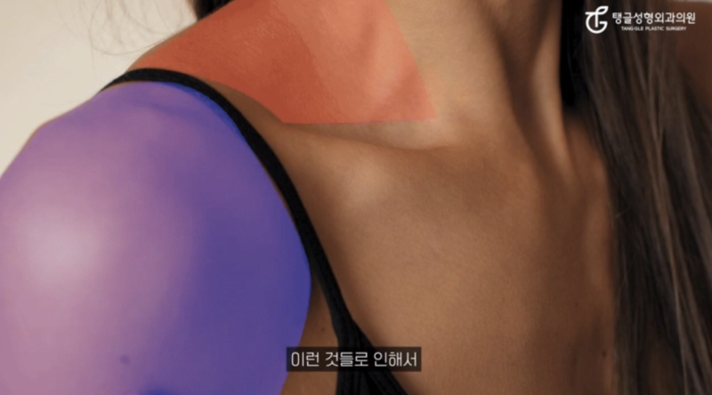 어깨필러, 직각어깨를 만드는 가장 빠른 방법은?
