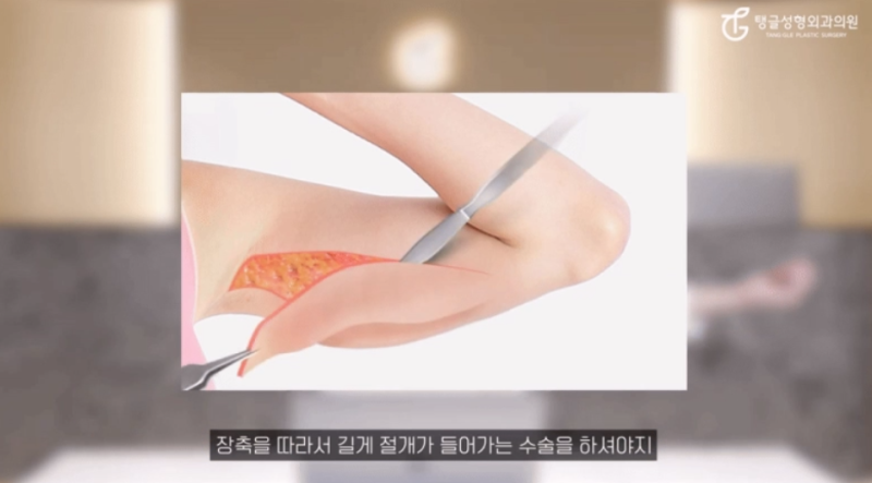 팔뚝거상, 모두에게 필요한가요?