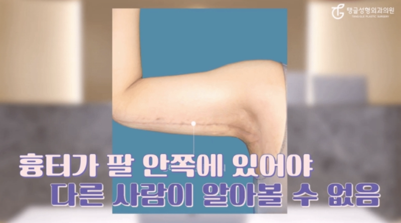팔뚝거상, 모두에게 필요한가요?