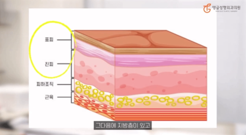 복부거상술, 꼭 해야 할까요? 사진 2