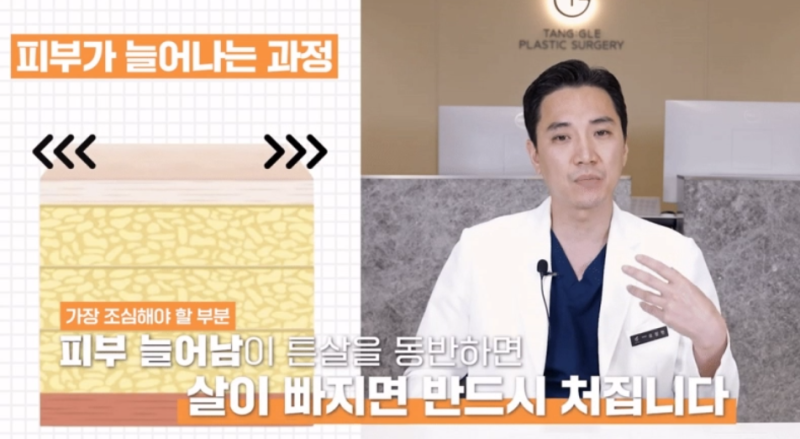 처진살수술, 급하게 다이어트 하셨나요? 사진 2