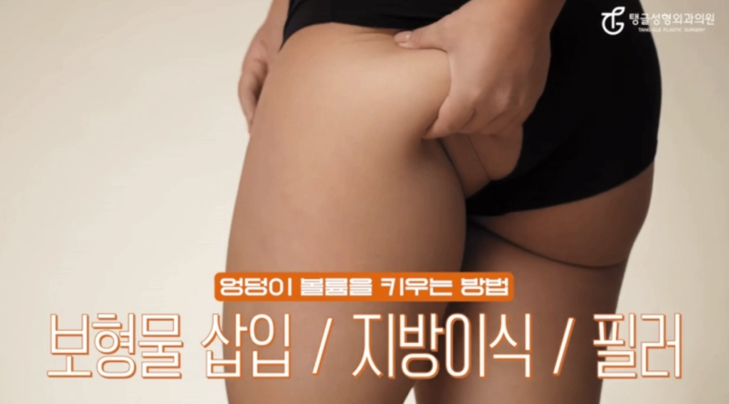엉덩이성형, 힙업거상술을 아세요? 사진 2