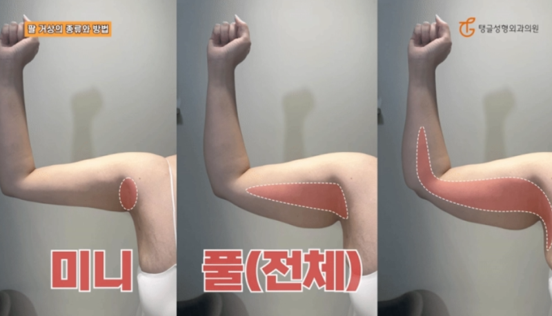 팔뚝성형, 처진 살로 고민이세요?