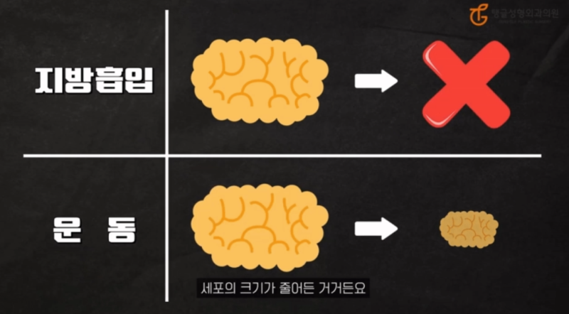 허벅지지방흡입 부작용, 알고 결정하세요! 사진 4