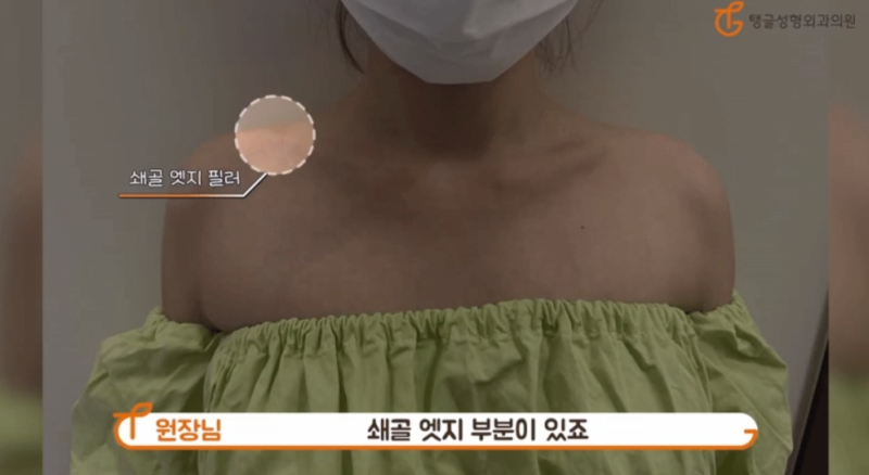 어깨필러가격, 옷태가 안 살아 고민이세요? 사진 2