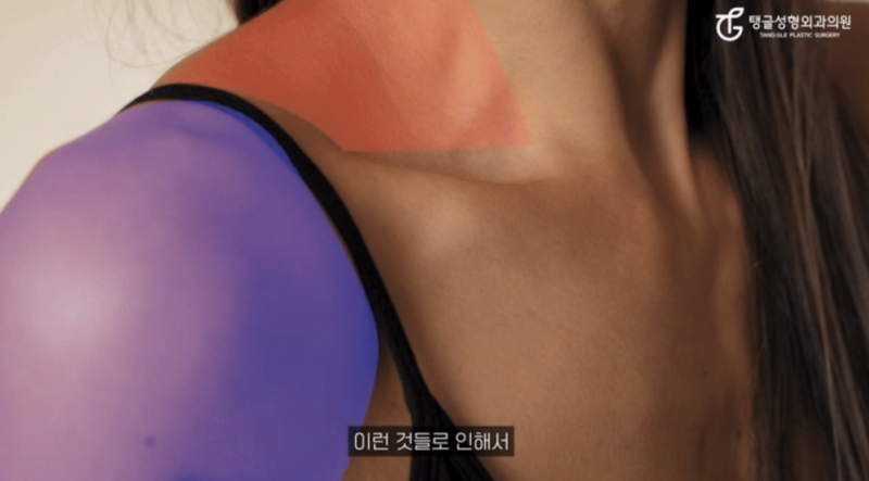어깨필러, 직각 라인 개선하려면 사진 3