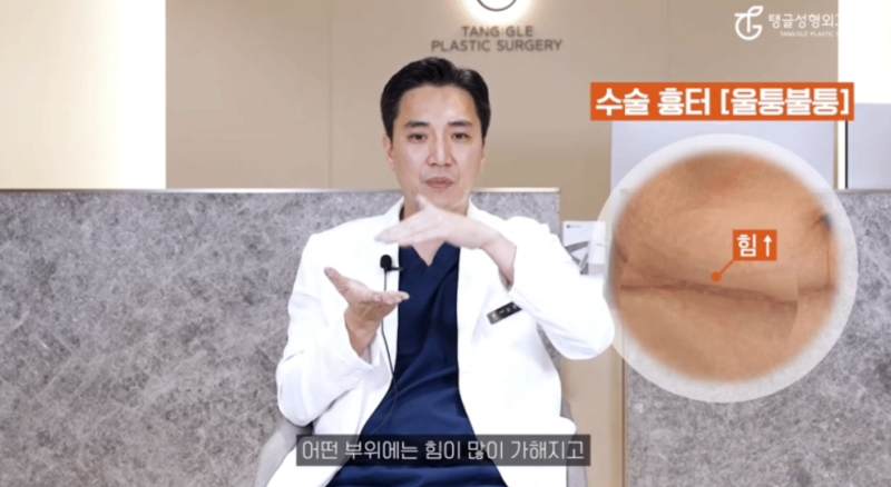 처진뱃살수술, 흉터 때문에 고민이신가요? 사진 4