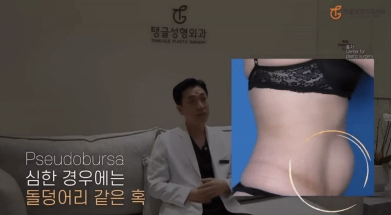 미니복부거상, 작은 절개와 빠른 회복 사진 3