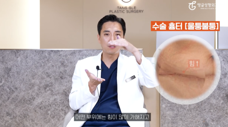 미니복부성형, 여름이 꺼려진다면