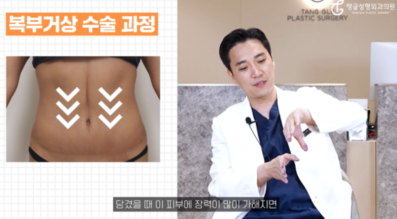 미니복부성형, 여름이 꺼려진다면