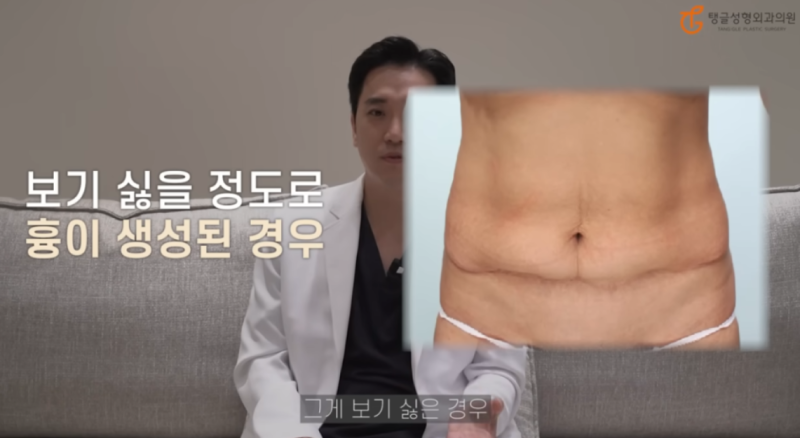 복부지방흡입 부작용, 살 빼는 건 평생 숙제? 사진 2