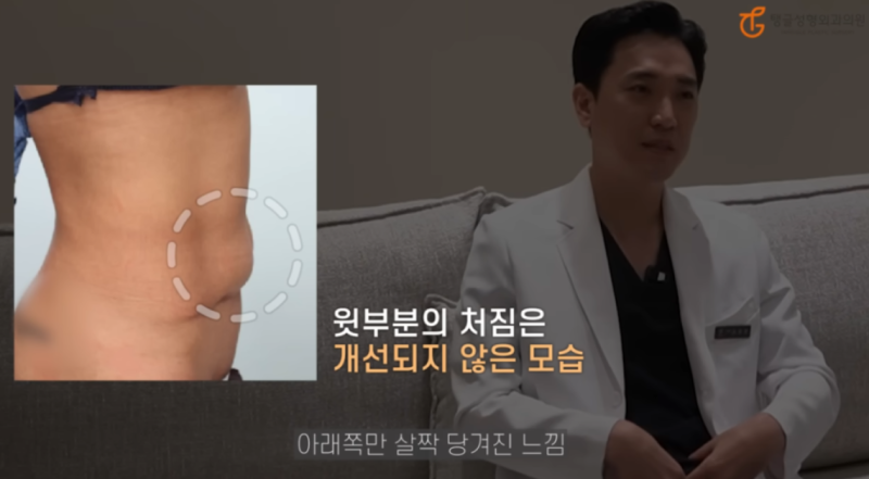 복부지방흡입 부작용, 살 빼는 건 평생 숙제?