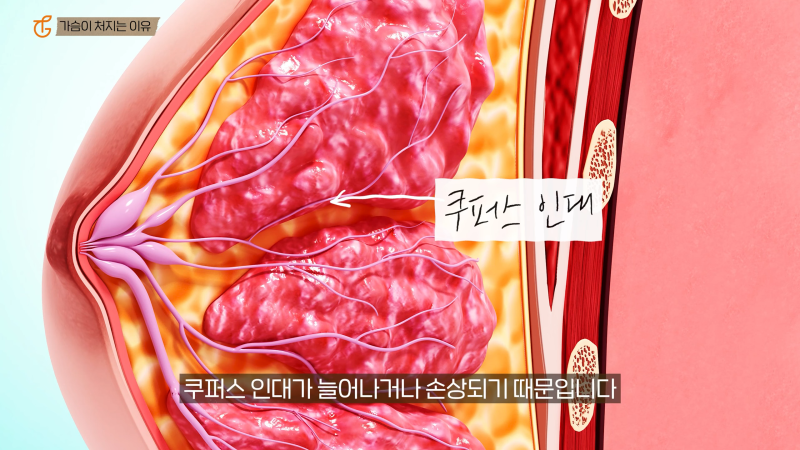 가슴거상수술, 처진 자신감까지 올리는법