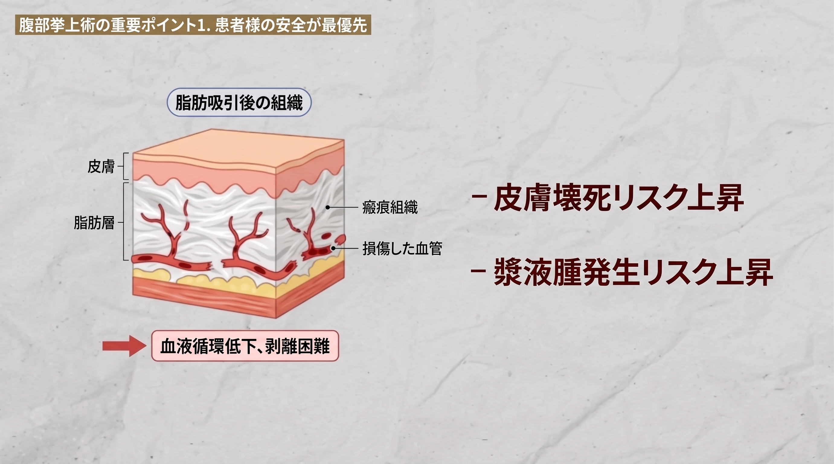 腹部挙上術の3つのポイント:手術前に必ず知っておきましょう。 사진 7