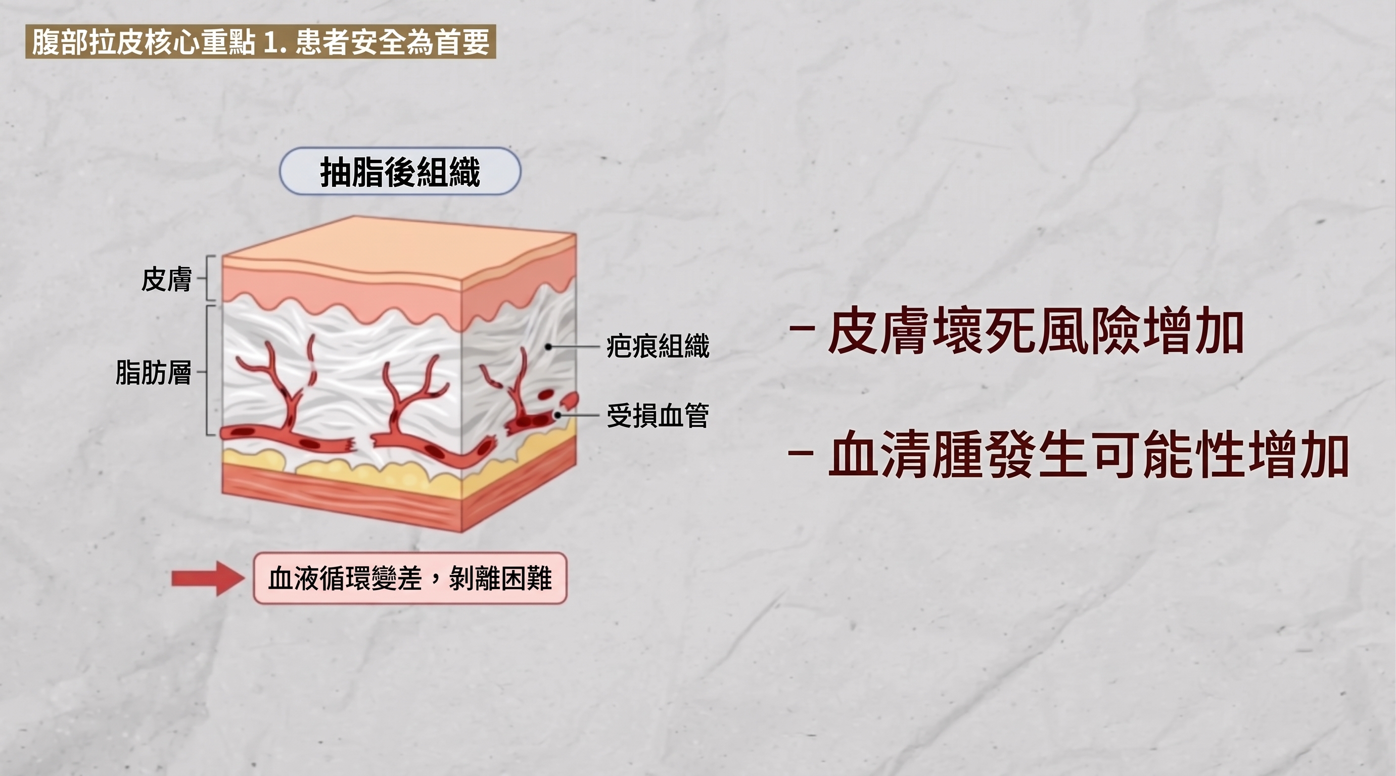 腹部拉皮三大重點：術前務必了解。 사진 7