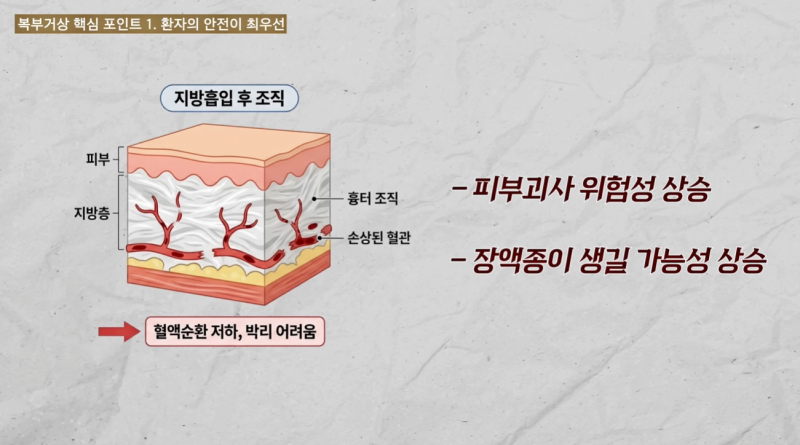 복부거상 3가지 포인트: 수술 전 꼭 알아두세요. 사진 7