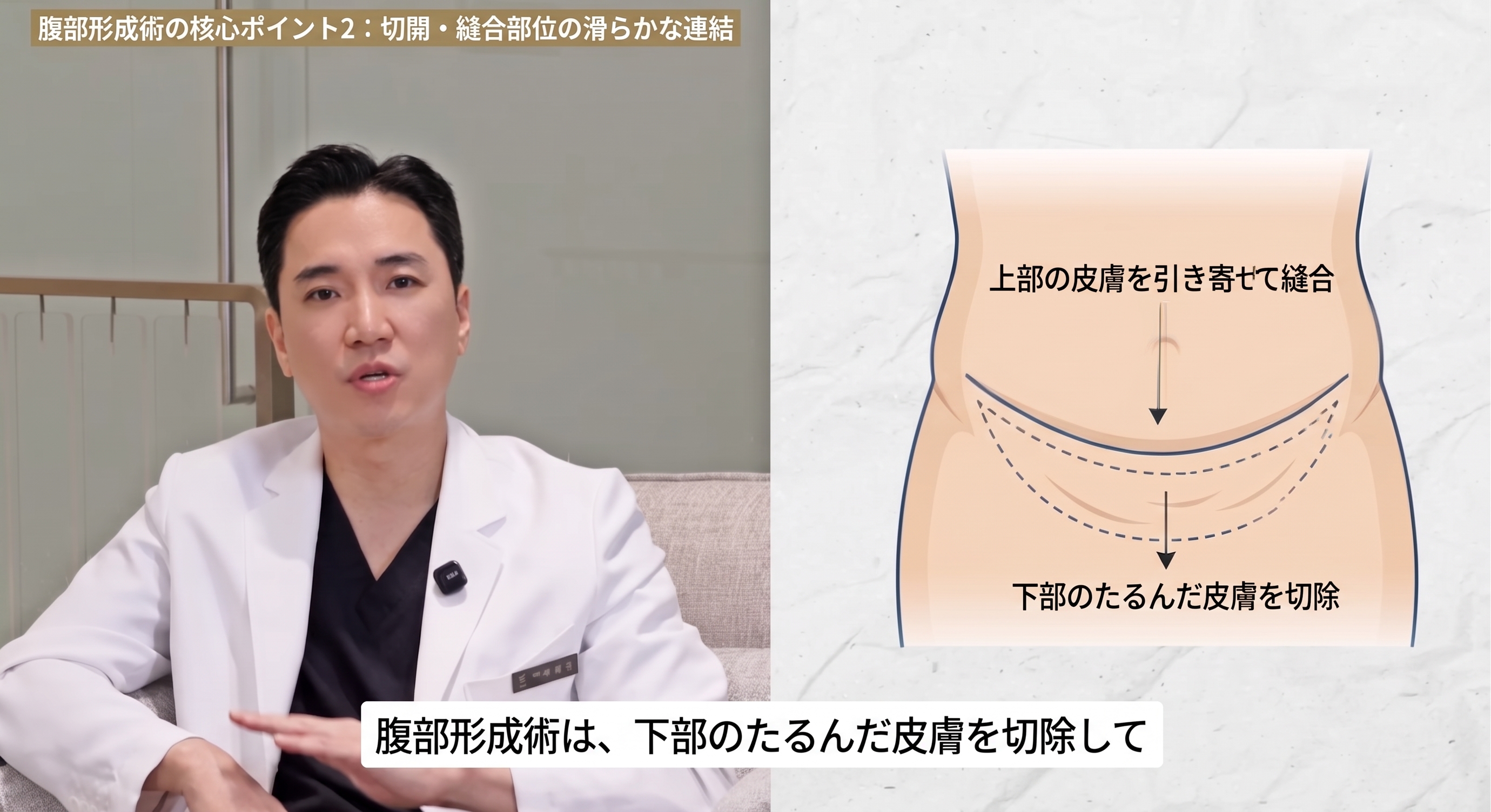 腹部挙上術の3つのポイント:手術前に必ず知っておきましょう。 사진 3