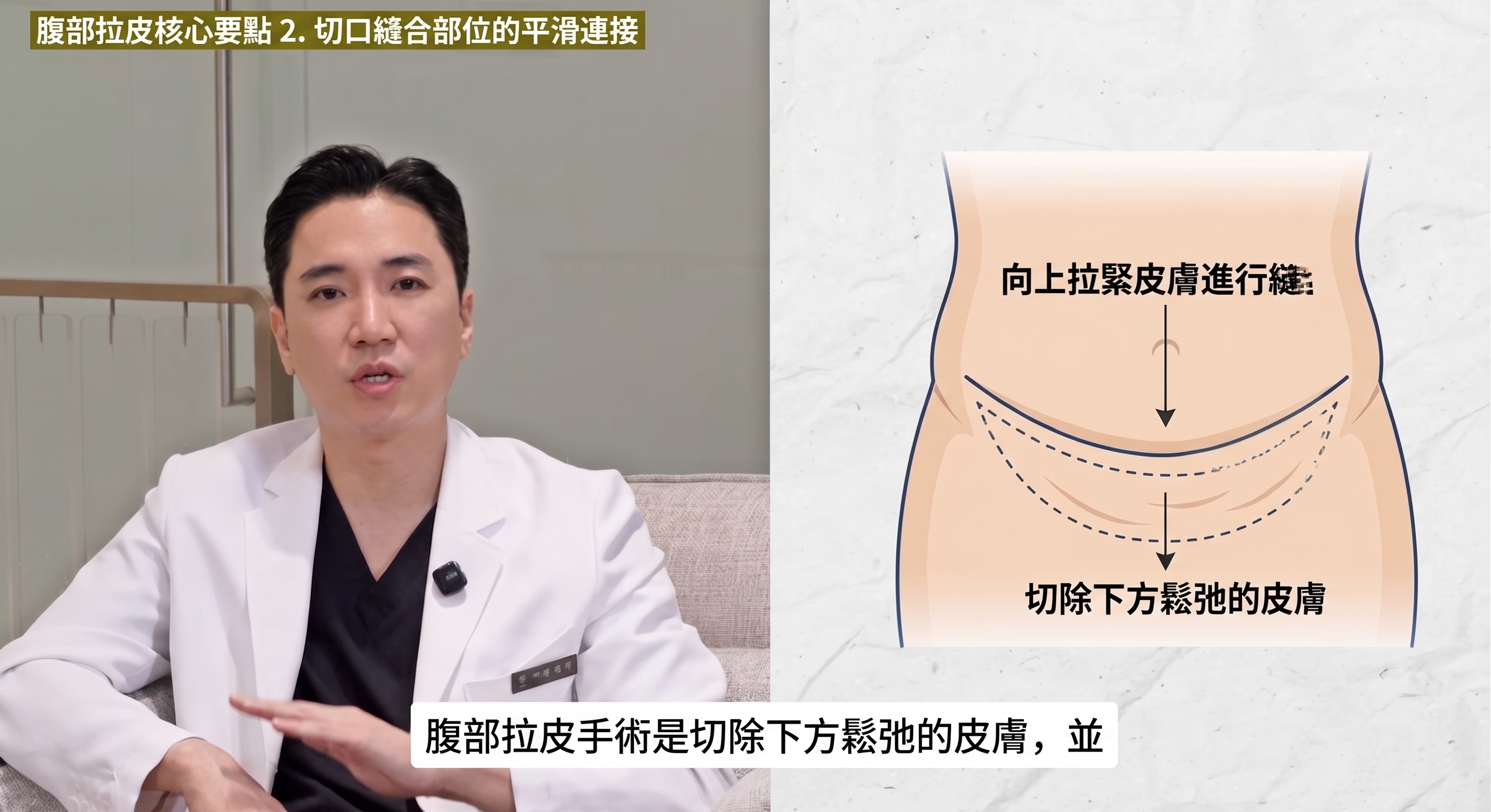 腹部拉皮三大重點：術前務必了解。 사진 3