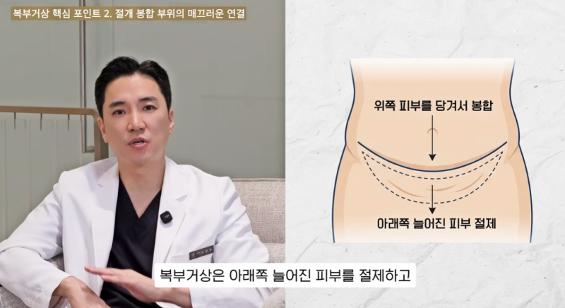 복부거상 3가지 포인트: 수술 전 꼭 알아두세요. 사진 3