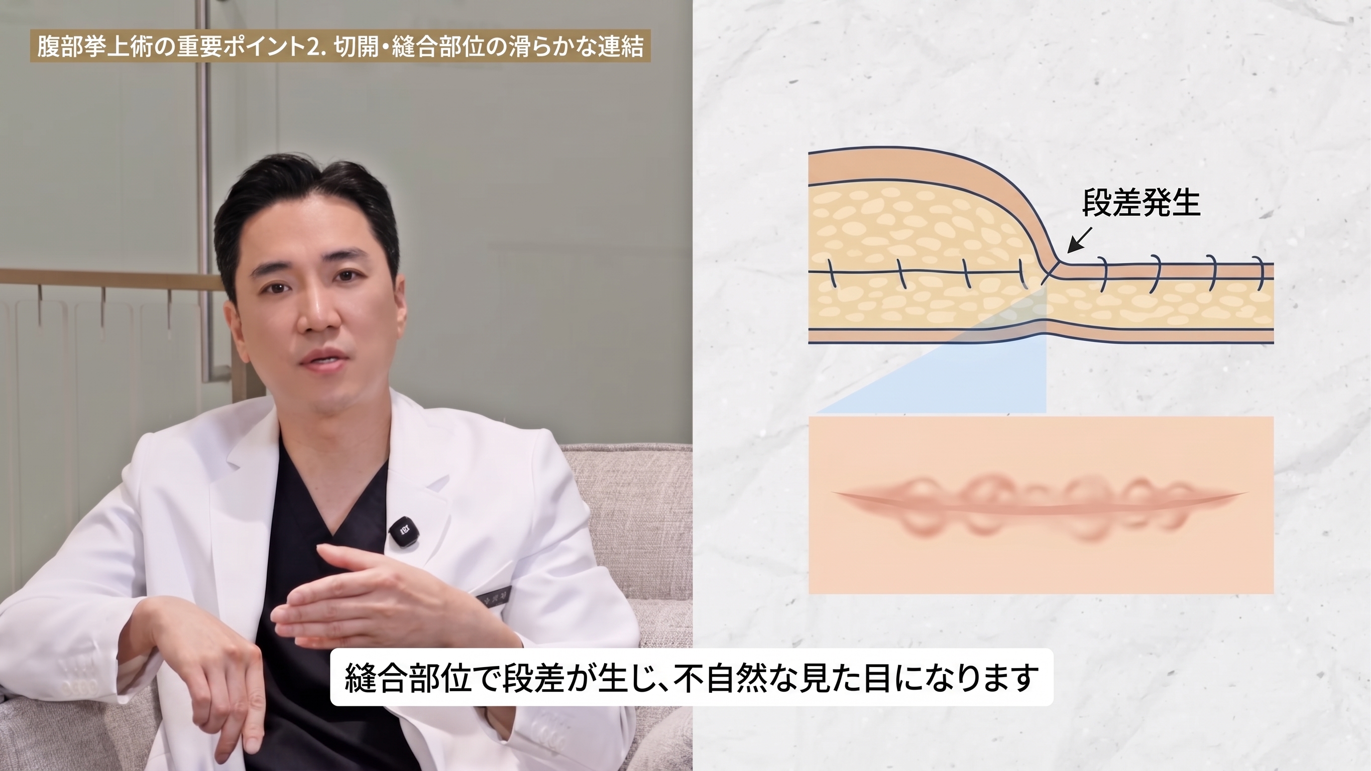 腹部挙上術の3つのポイント:手術前に必ず知っておきましょう。 사진 4