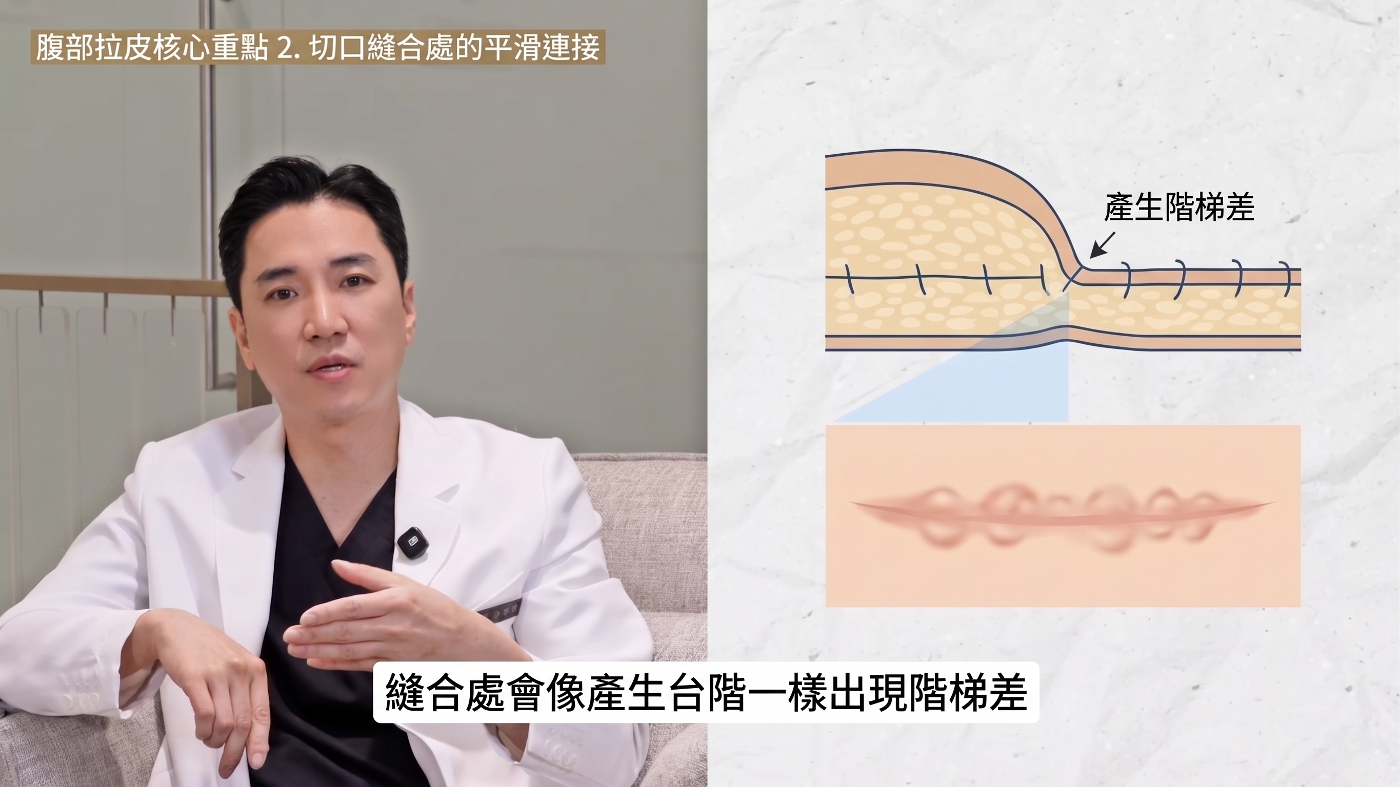 腹部拉皮三大重點：術前務必了解。 사진 4