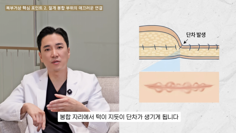 복부거상 3가지 포인트: 수술 전 꼭 알아두세요.