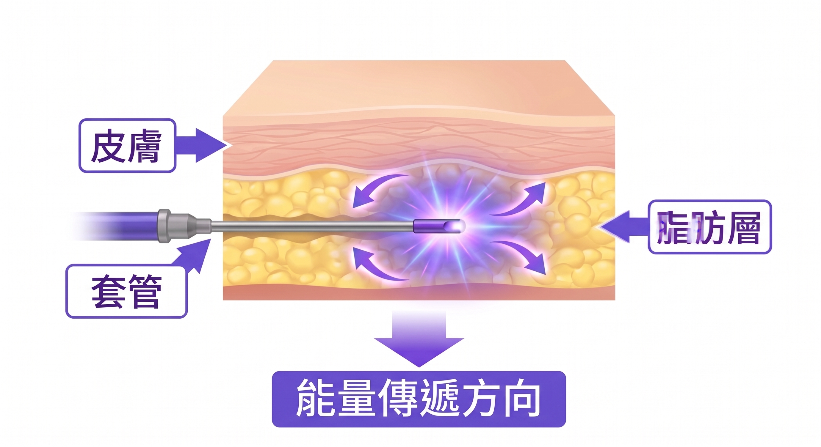 腹部緊緻Renuvion您好奇嗎？從效果到恢復！ 사진 2