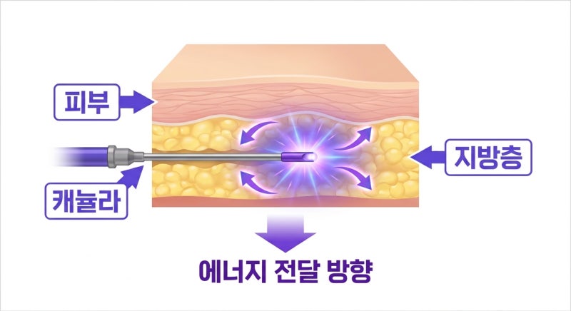 복부 타이트닝 리뉴비온 궁금하신가요? 효과부터 회복까지!