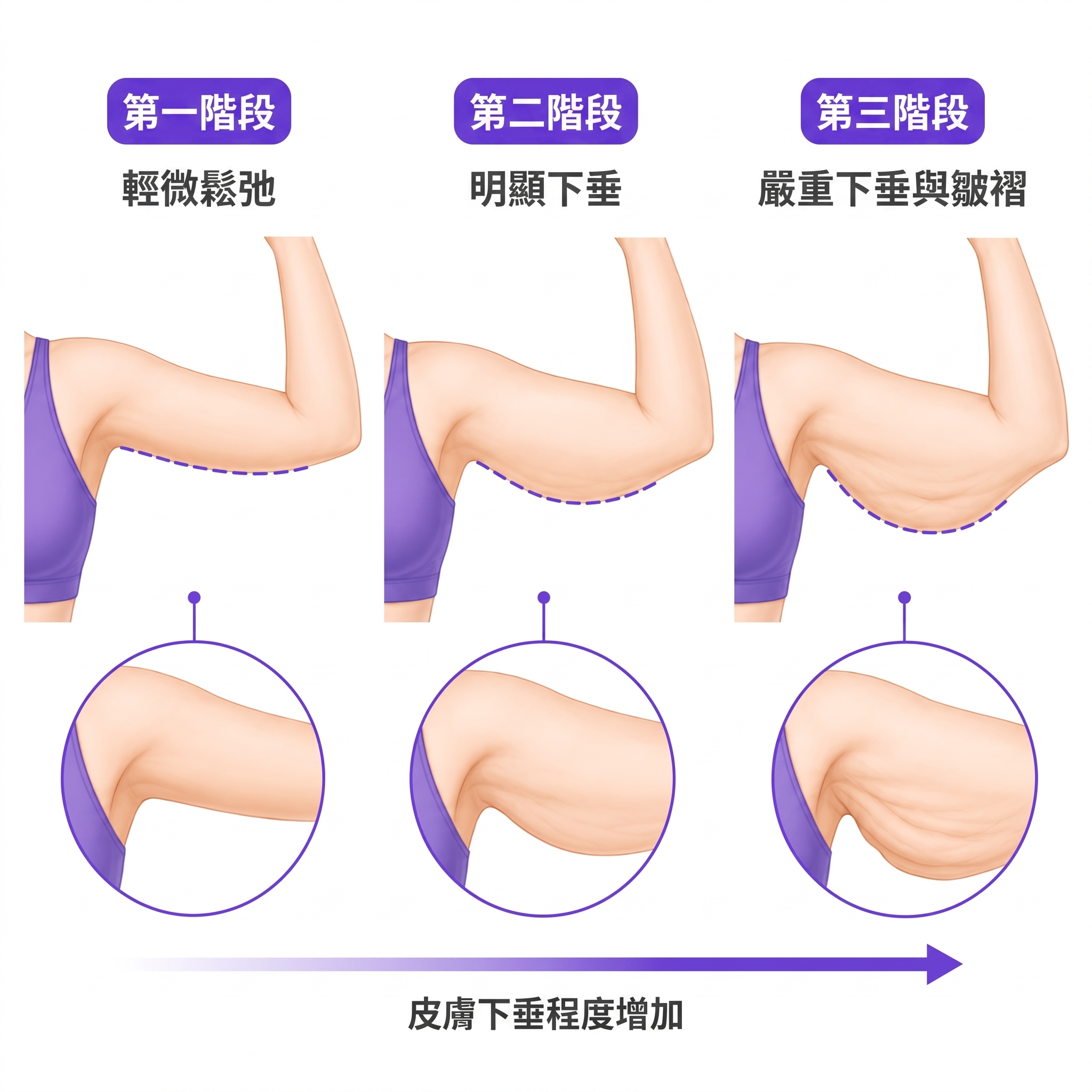 體重減輕後的手臂拉提 | 您現在需要知道的關鍵資訊 사진 2