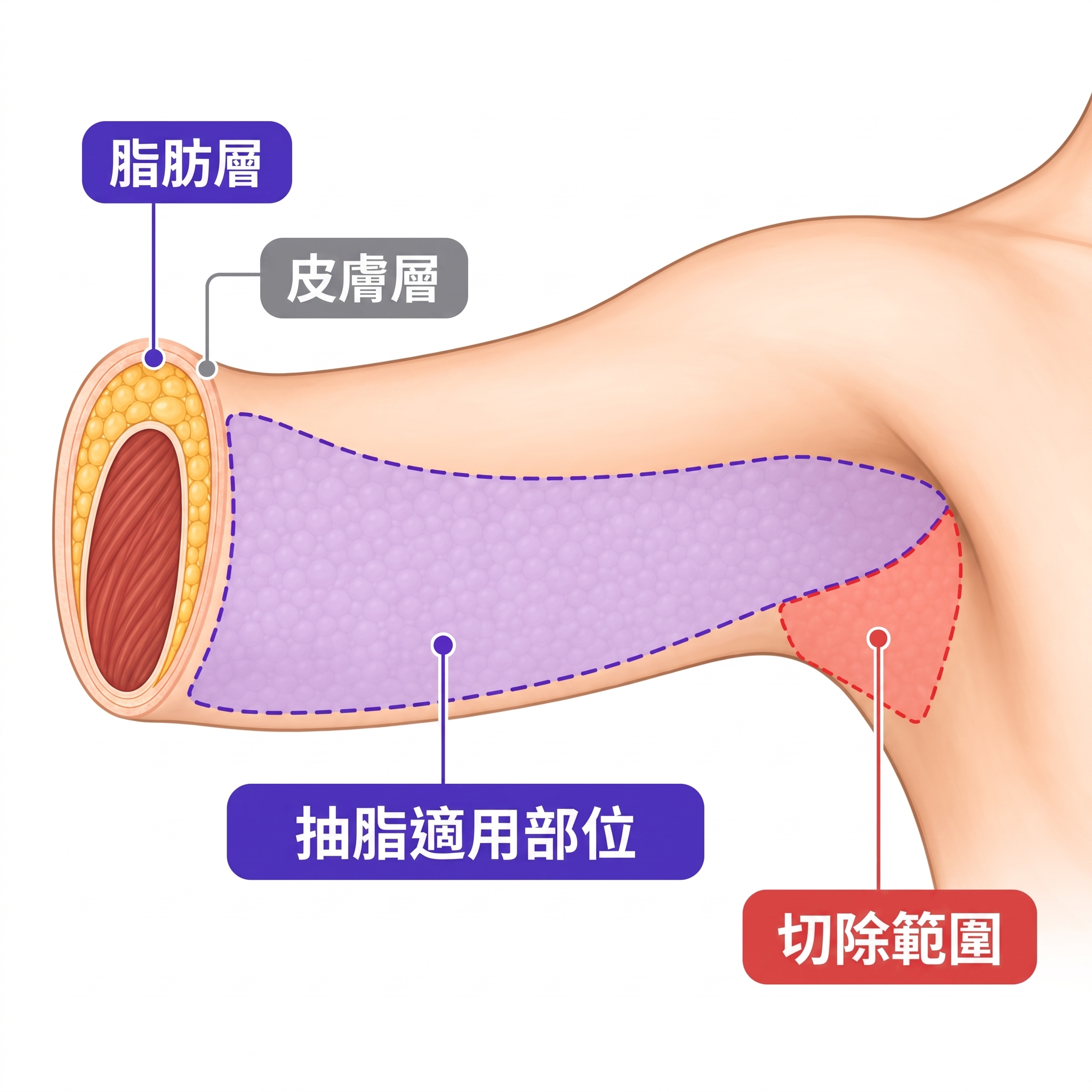 體重減輕後的手臂拉提 | 您現在需要知道的關鍵資訊 사진 5