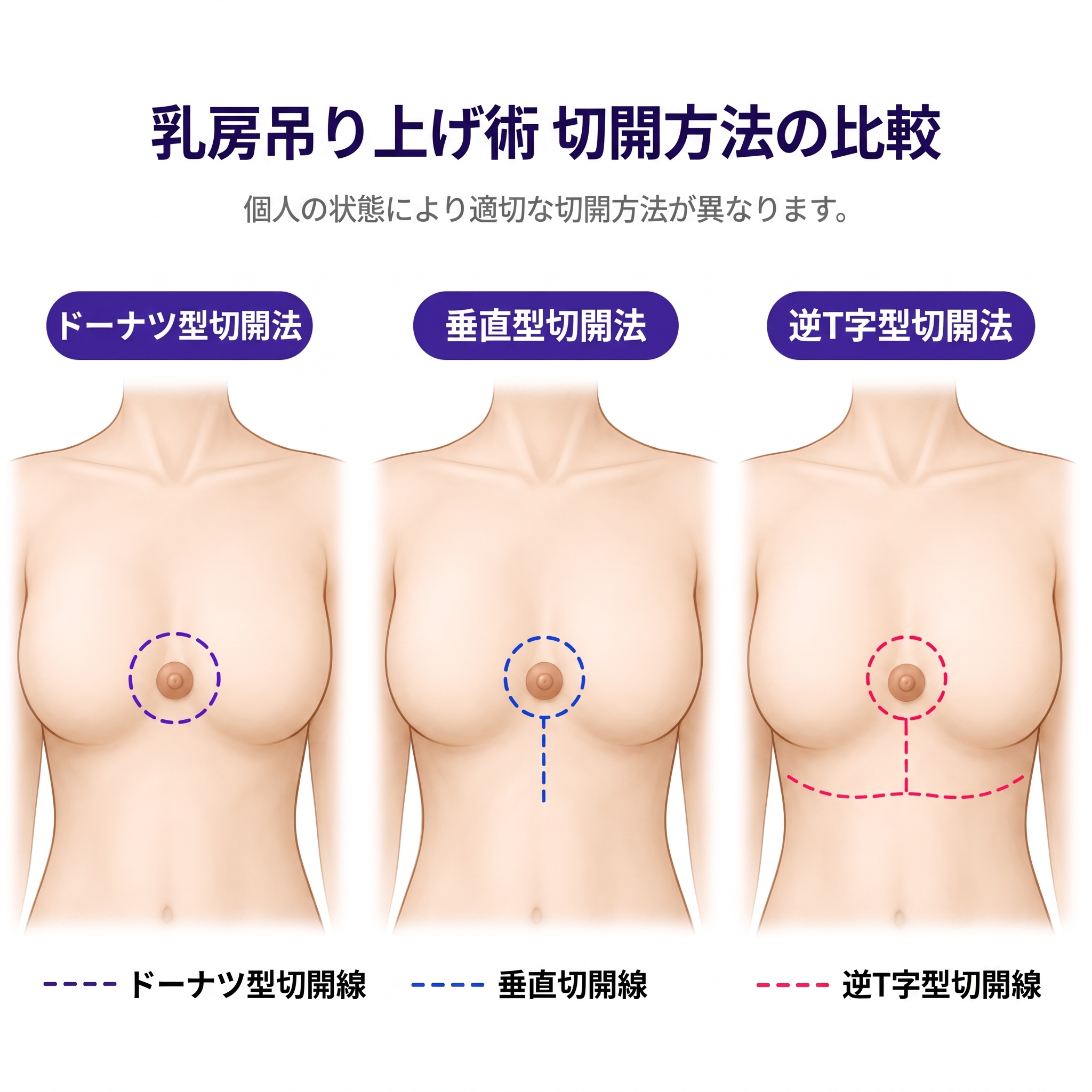 知らないと損する、垂れた胸を改善する乳房吊り上げ術(マストペクシー)|今すぐ知っておくべき全知識 사진 4