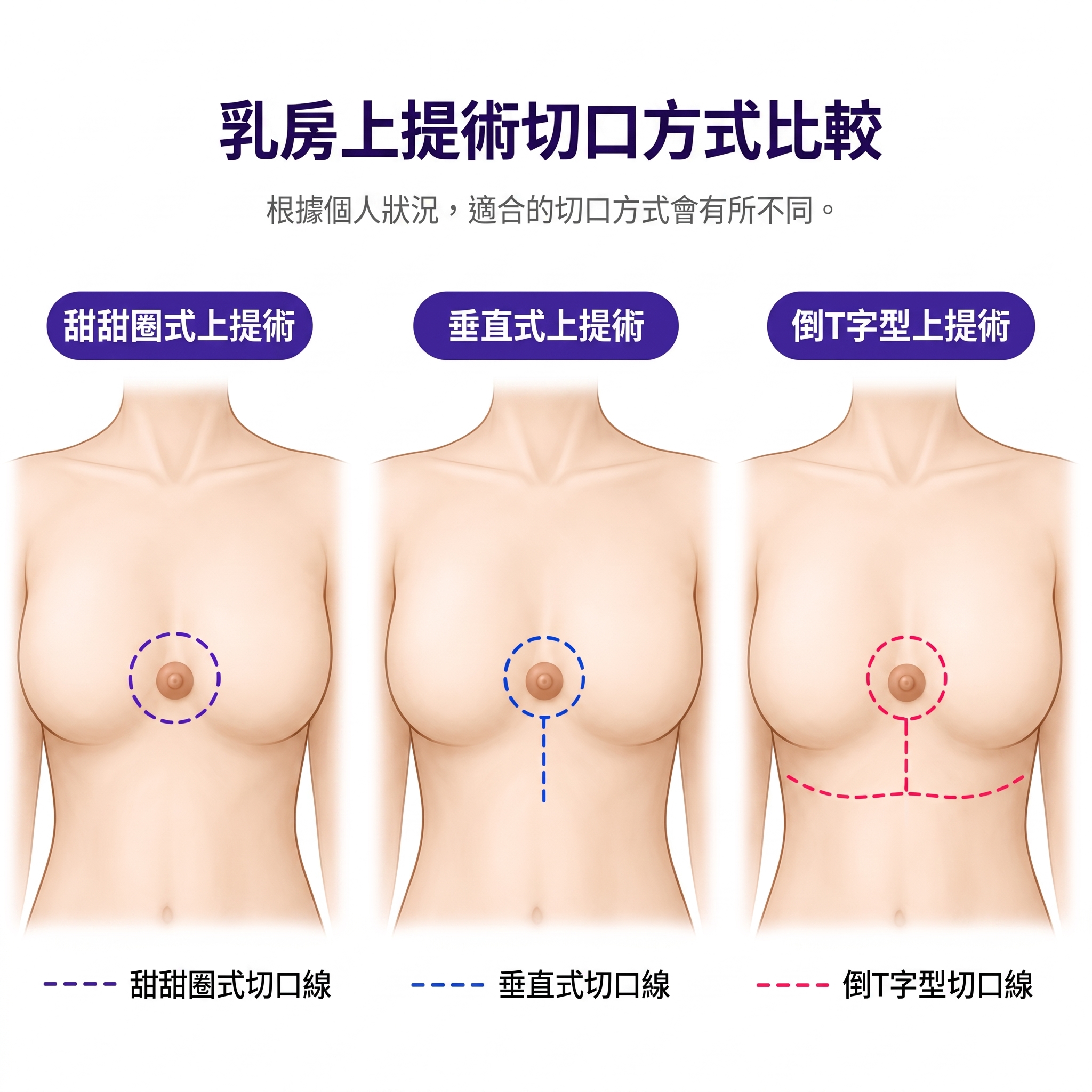 不知虧大,乳房下垂提乳手術 | 現在必須了解的一切 사진 4