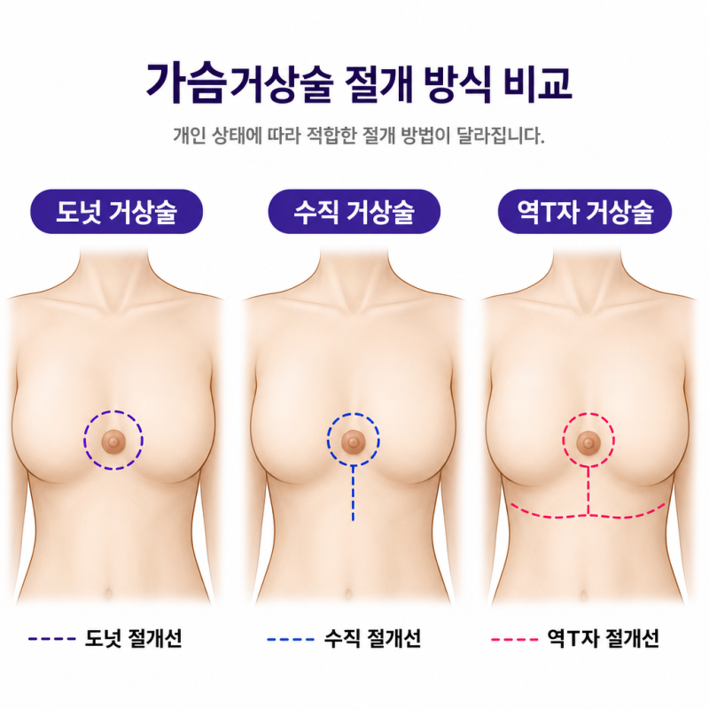 모르면 손해, 처진가슴 가슴거상술 | 지금 당장 알아야 할 모든 것 사진 4