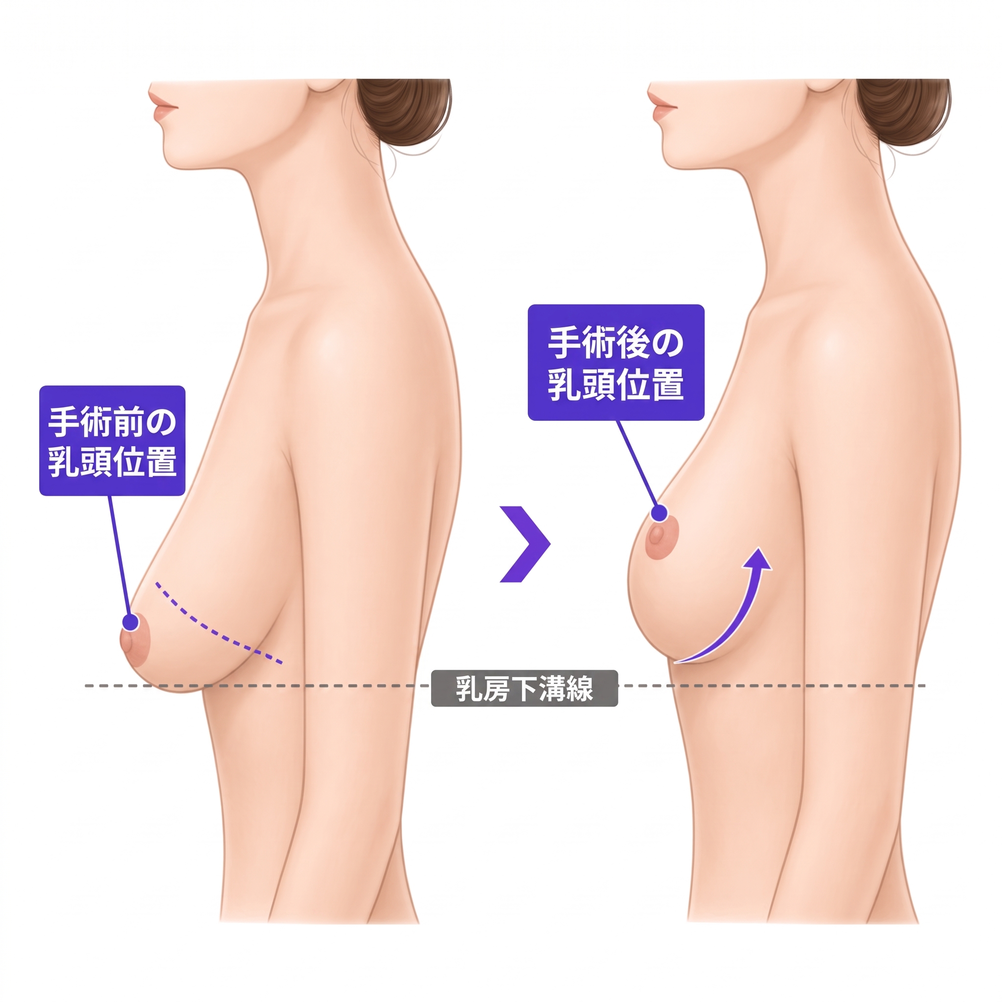 知らないと損する、垂れた胸を改善する乳房吊り上げ術(マストペクシー)|今すぐ知っておくべき全知識 사진 3