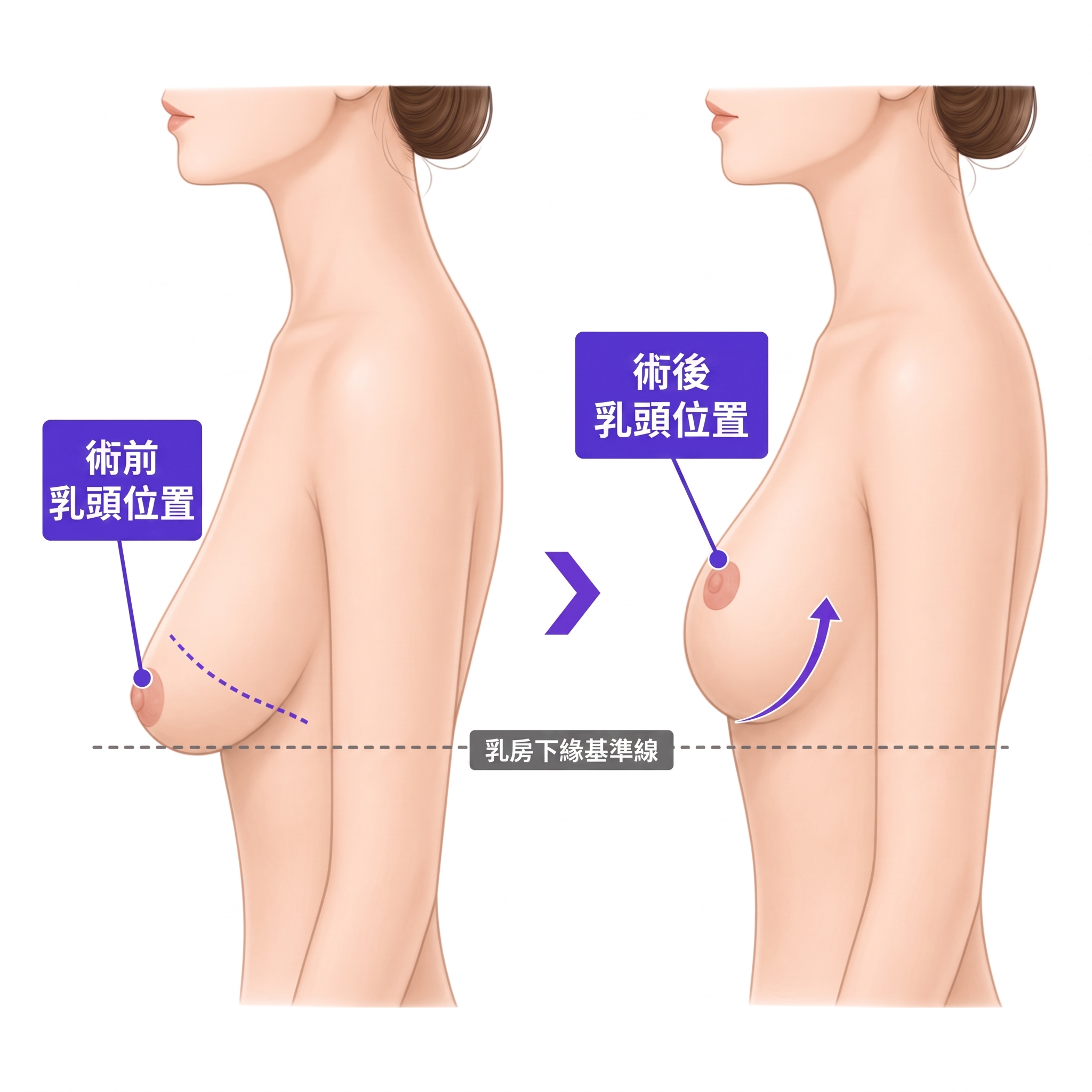 不知虧大,乳房下垂提乳手術 | 現在必須了解的一切 사진 3