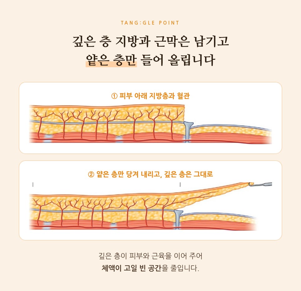 처진 뱃살, 복부거상 수술로 해결하는 방법 사진 8