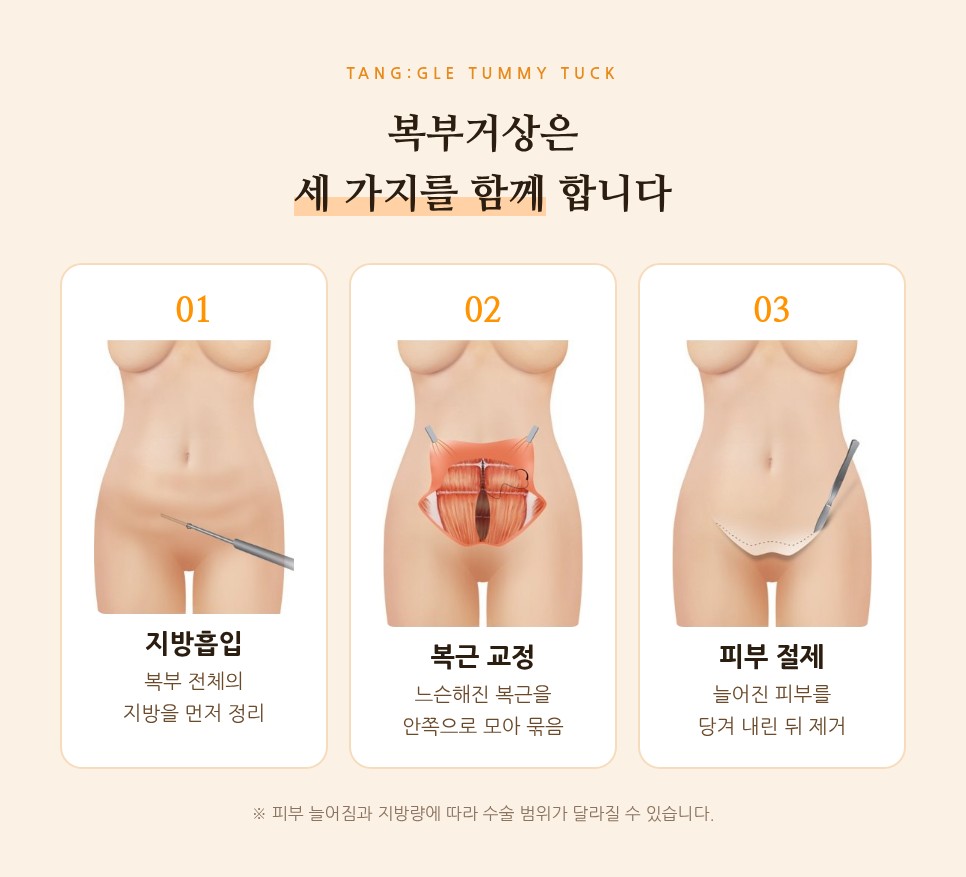 처진 뱃살, 복부거상 수술로 해결하는 방법 사진 5