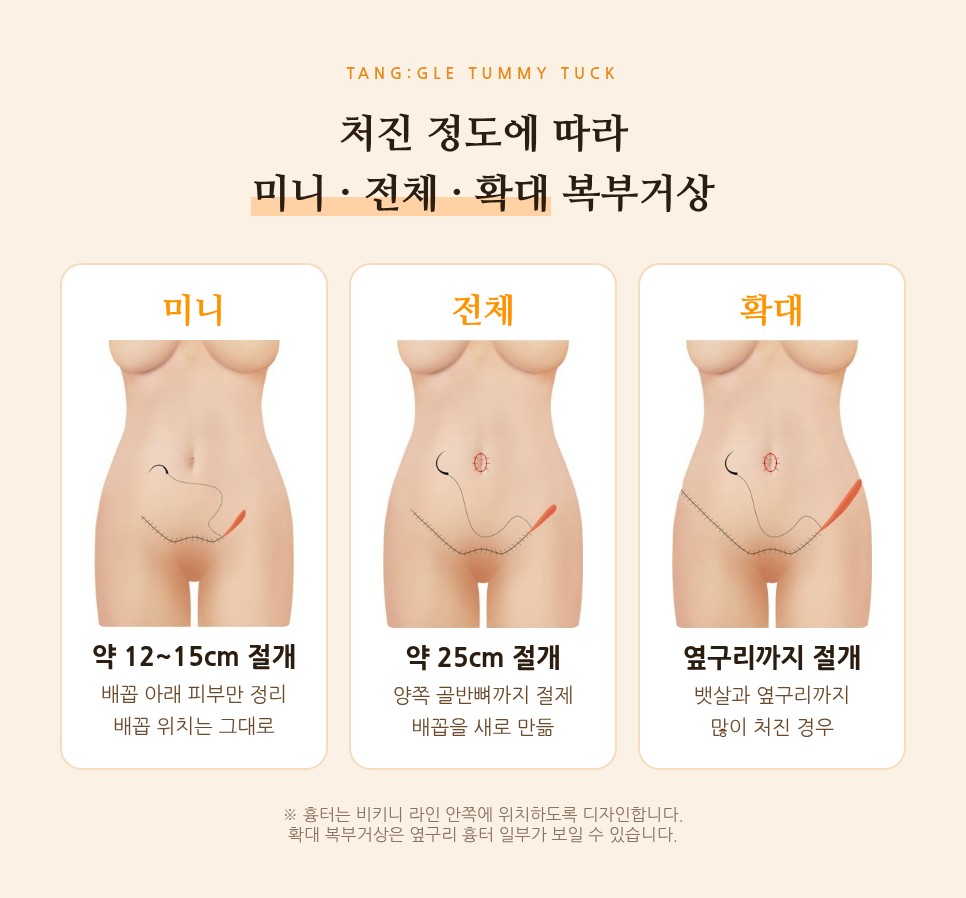 처진 뱃살, 복부거상 수술로 해결하는 방법 사진 7
